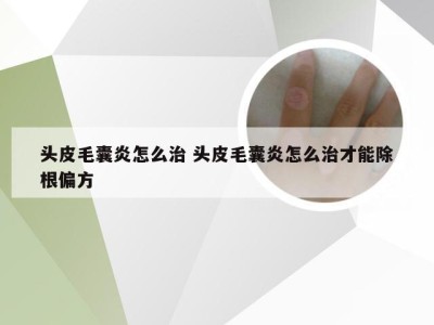 头皮毛囊炎怎么治 头皮毛囊炎怎么治才能除根偏方