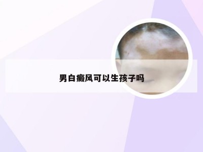 男白癜风可以生孩子吗