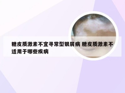 糖皮质激素不宜寻常型银屑病 糖皮质激素不适用于哪些疾病