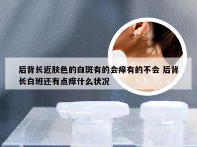 后背长近肤色的白斑有的会痒有的不会 后背长白班还有点痒什么状况