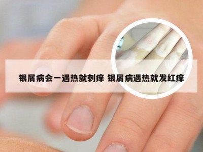 银屑病会一遇热就刺痒 银屑病遇热就发红痒