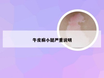 牛皮癣小腿严重说明