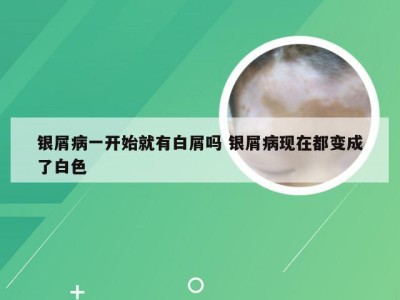 银屑病一开始就有白屑吗 银屑病现在都变成了白色