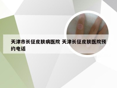 天津市长征皮肤病医院 天津长征皮肤医院预约电话