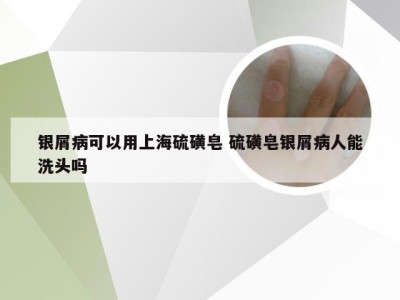 银屑病可以用上海硫磺皂 硫磺皂银屑病人能洗头吗