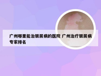 广州哪里能治银屑病的医院 广州治疗银屑病专家排名