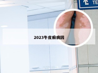 2023牛皮癣病因