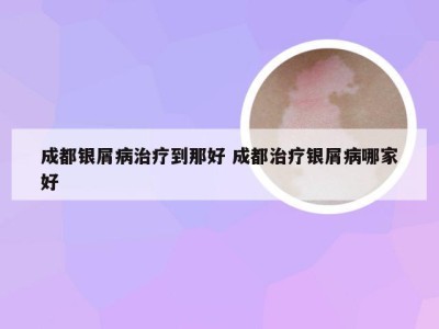 成都银屑病治疗到那好 成都治疗银屑病哪家好