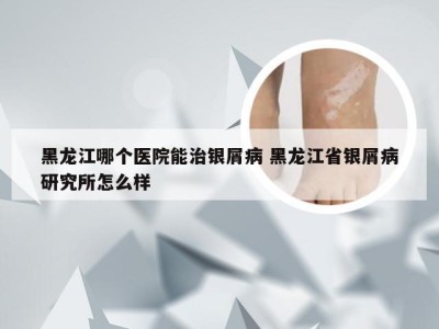 黑龙江哪个医院能治银屑病 黑龙江省银屑病研究所怎么样