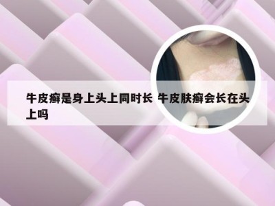 牛皮癣是身上头上同时长 牛皮肤癣会长在头上吗