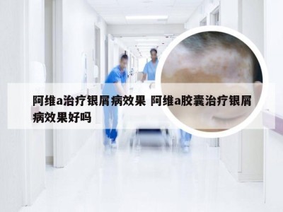 阿维a治疗银屑病效果 阿维a胶囊治疗银屑病效果好吗