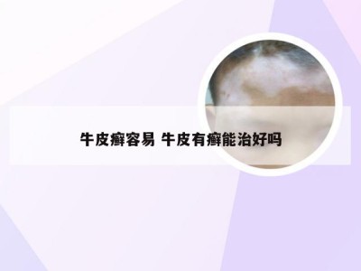 牛皮癣容易 牛皮有癣能治好吗