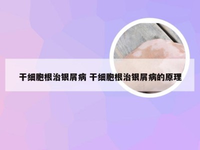 干细胞根治银屑病 干细胞根治银屑病的原理