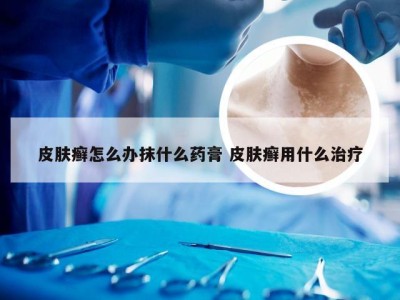 皮肤癣怎么办抹什么药膏 皮肤癣用什么治疗