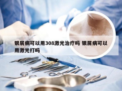 银屑病可以用308激光治疗吗 银屑病可以用激光打吗