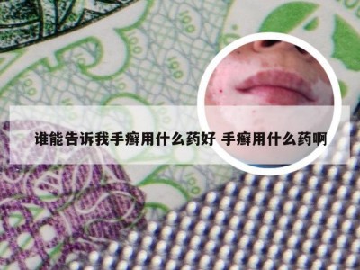 谁能告诉我手癣用什么药好 手癣用什么药啊