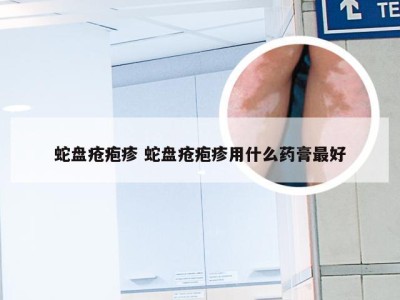 蛇盘疮疱疹 蛇盘疮疱疹用什么药膏最好