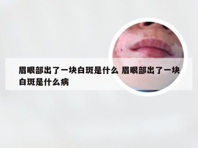 眉眼部出了一块白斑是什么 眉眼部出了一块白斑是什么病