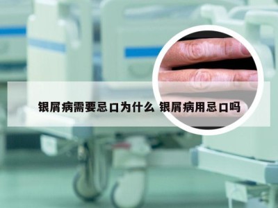 银屑病需要忌口为什么 银屑病用忌口吗