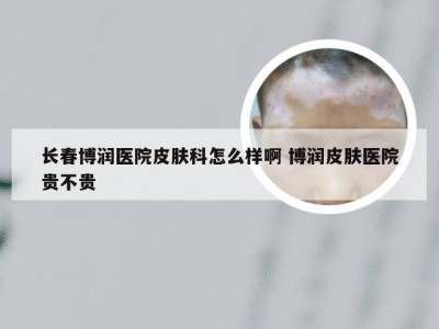 长春博润医院皮肤科怎么样啊 博润皮肤医院贵不贵