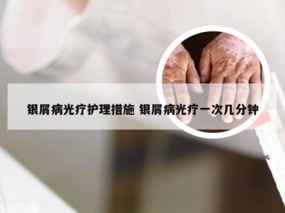 银屑病光疗护理措施 银屑病光疗一次几分钟