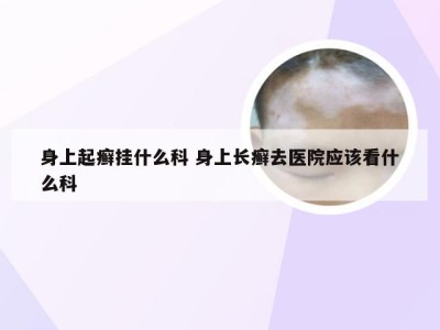 身上起癣挂什么科 身上长癣去医院应该看什么科