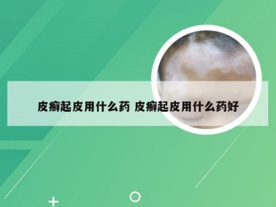 皮癣起皮用什么药 皮癣起皮用什么药好