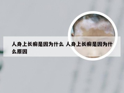 人身上长癣是因为什么 人身上长癣是因为什么原因