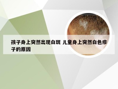 孩子身上突然出现白斑 儿童身上突然白色疹子的原因