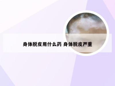 身体脱皮用什么药 身体脱皮严重