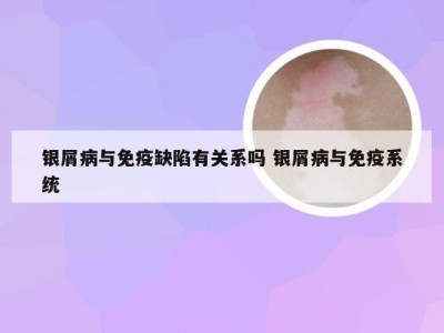 银屑病与免疫缺陷有关系吗 银屑病与免疫系统