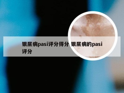 银屑病pasi评分得分 银屑病的pasi评分