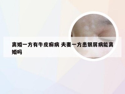 离婚一方有牛皮癣病 夫妻一方患银屑病能离婚吗