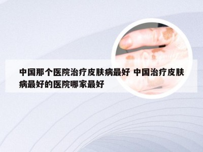 中国那个医院治疗皮肤病最好 中国治疗皮肤病最好的医院哪家最好