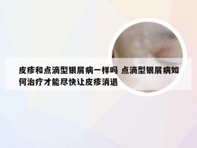 皮疹和点滴型银屑病一样吗 点滴型银屑病如何治疗才能尽快让皮疹消退