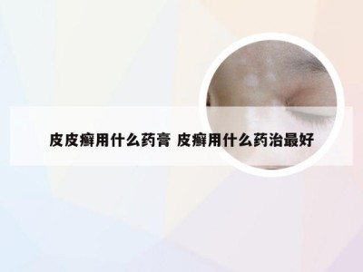 皮皮癣用什么药膏 皮癣用什么药治最好