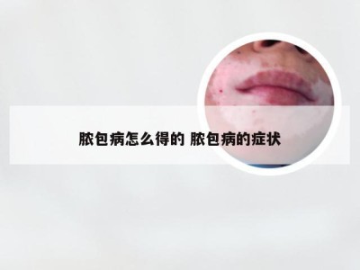 脓包病怎么得的 脓包病的症状