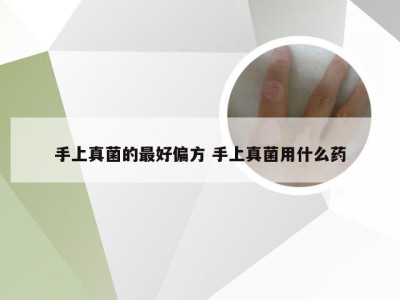 手上真菌的最好偏方 手上真菌用什么药