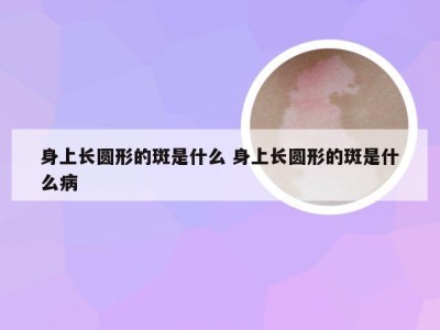 身上长圆形的斑是什么 身上长圆形的斑是什么病