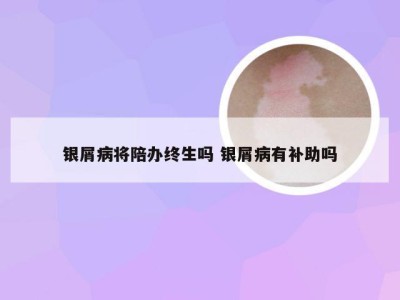 银屑病将陪办终生吗 银屑病有补助吗