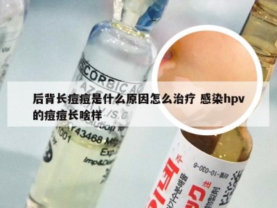 后背长痘痘是什么原因怎么治疗 感染hpv的痘痘长啥样