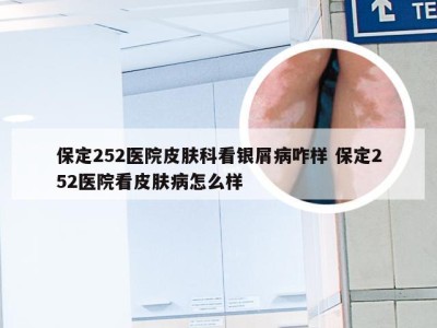 保定252医院皮肤科看银屑病咋样 保定252医院看皮肤病怎么样