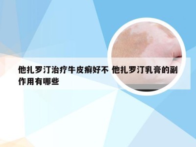 他扎罗汀治疗牛皮癣好不 他扎罗汀乳膏的副作用有哪些