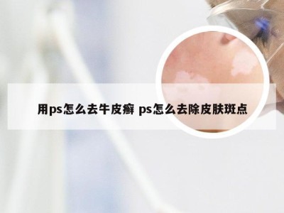 用ps怎么去牛皮癣 ps怎么去除皮肤斑点