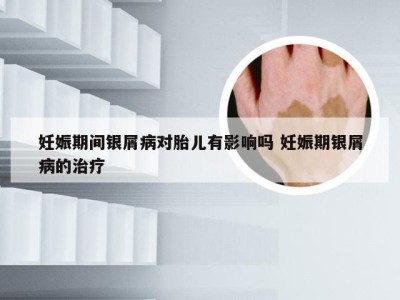 妊娠期间银屑病对胎儿有影响吗 妊娠期银屑病的治疗