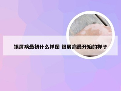 银屑病最初什么样图 银屑病最开始的样子