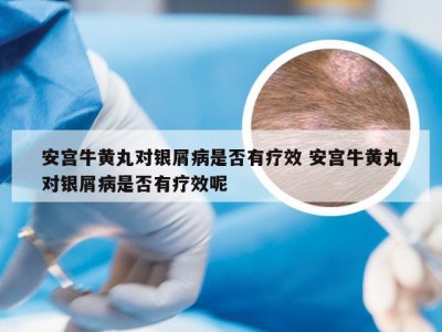 安宫牛黄丸对银屑病是否有疗效 安宫牛黄丸对银屑病是否有疗效呢