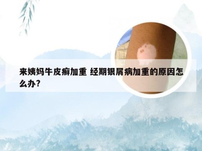 来姨妈牛皮癣加重 经期银屑病加重的原因怎么办?