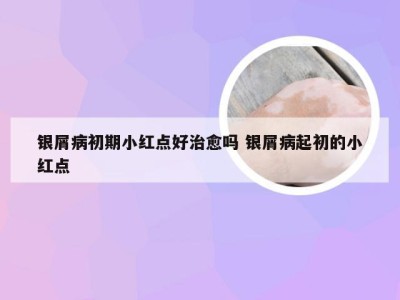 银屑病初期小红点好治愈吗 银屑病起初的小红点