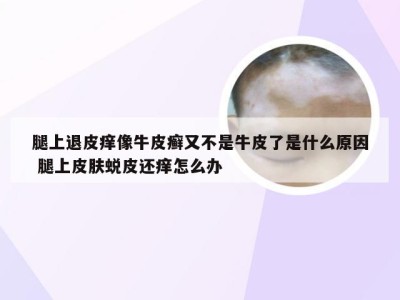 腿上退皮痒像牛皮癣又不是牛皮了是什么原因 腿上皮肤蜕皮还痒怎么办